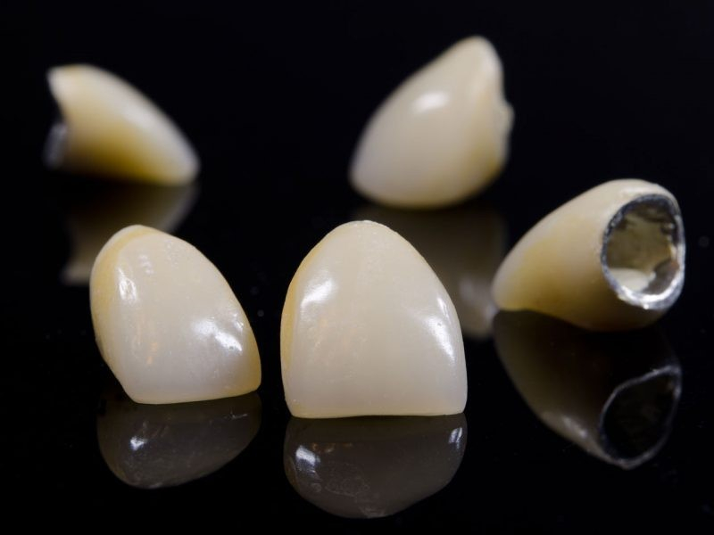 تعرفه دندانپزشکی 1401 برای انواع روکش دندان چقدر است؟