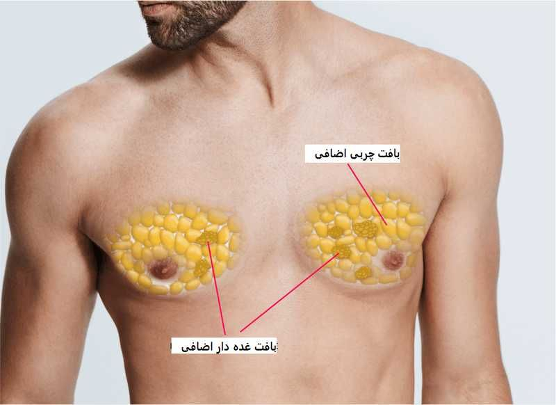 ژنیکوماستی ( بزرگی پستان در مردان )