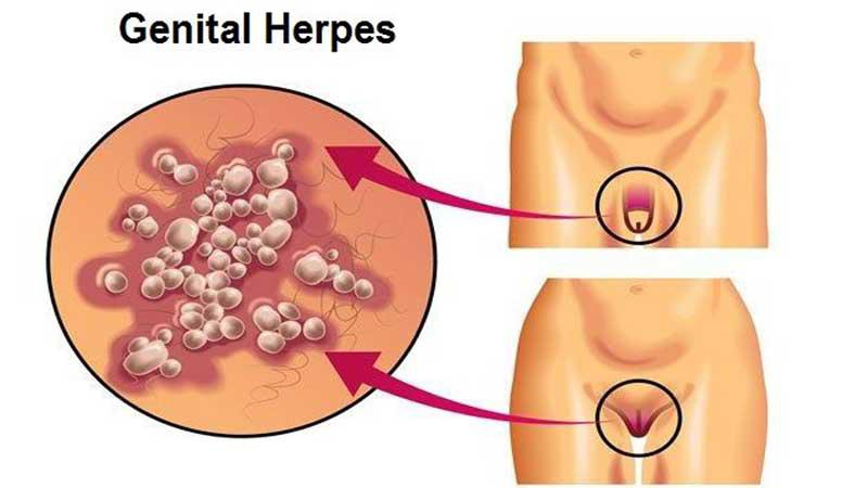 کلینیک تخصصی زنان دکتر روشن؛ آیا HPV منجر به مرگ می شود؟
