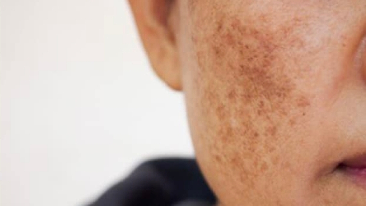 آلودگی هوا و پوست؛ چگونه از التهاب و خطر سرطان پیشگیری کنیم؟