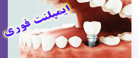 ایمپلنت فوری چیست و اشاره به بهترین کلینیک ایمپلنت دندان