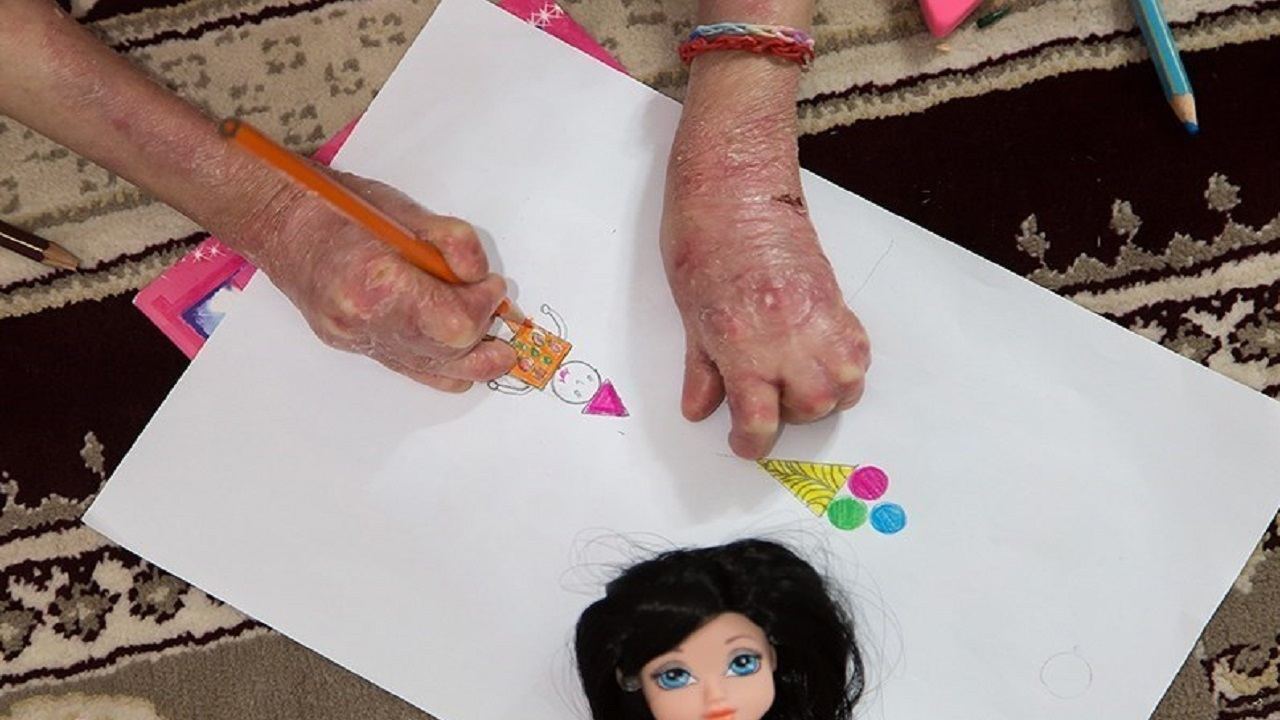 بنیاد امور بیماریهای خاص به مطالبات بیماران پروانهای پاسخی نمی دهد