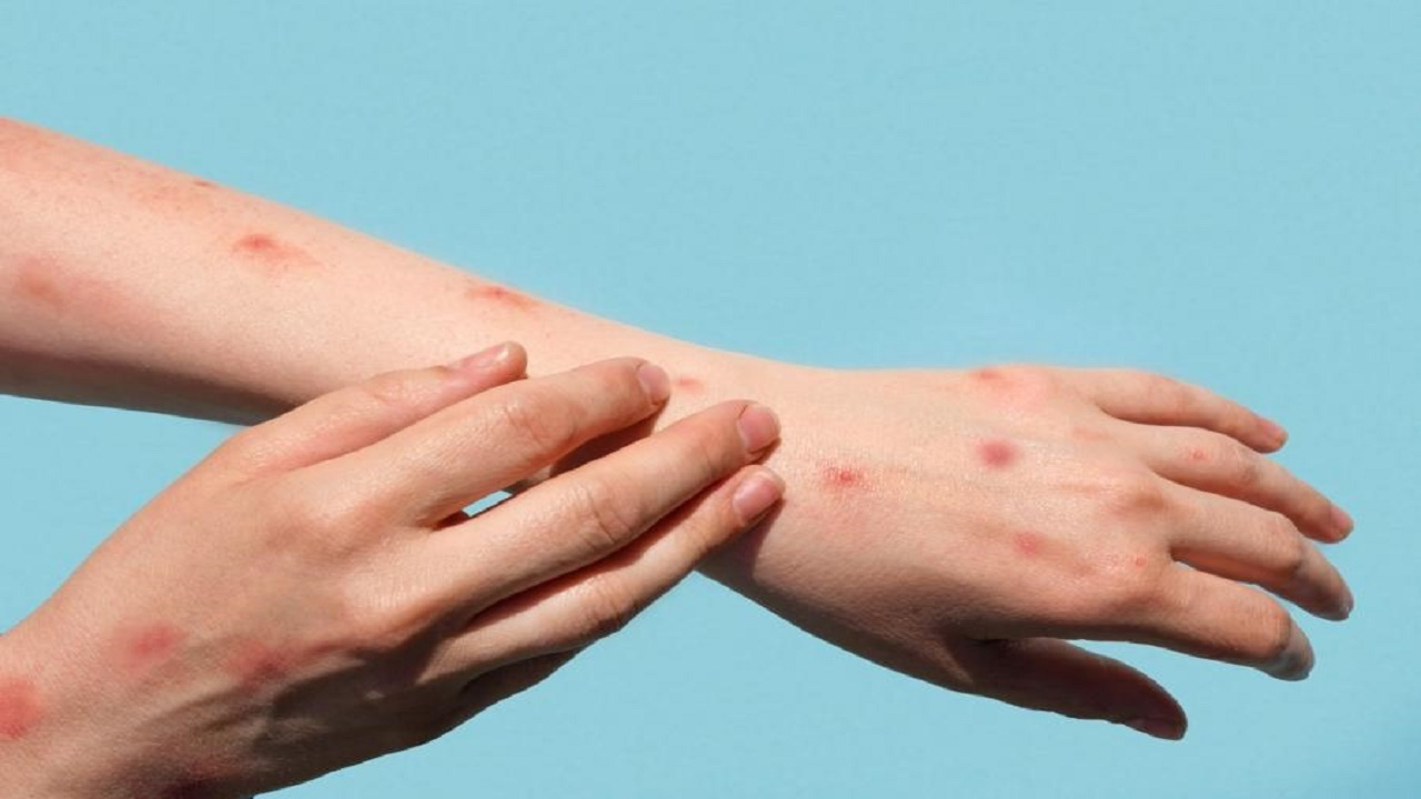 یک علت غیرمنتظره برای زخمهای پوستی