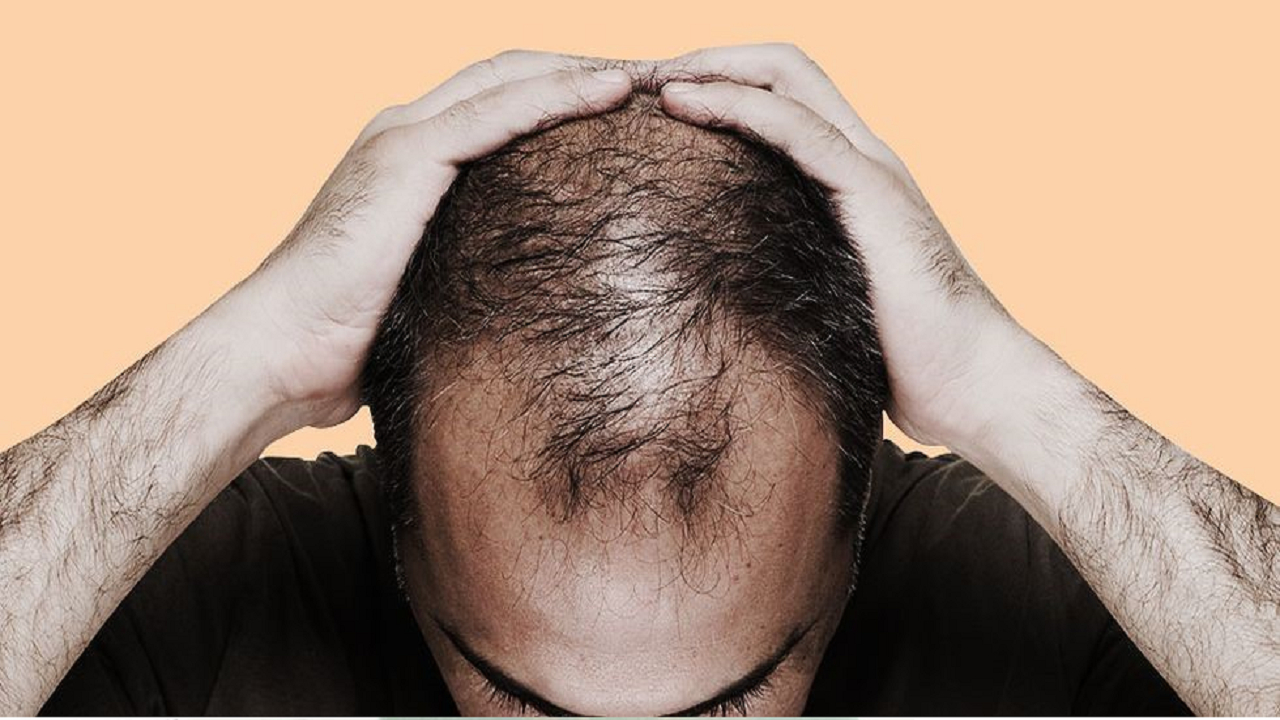 چگونه استرس فولیکولهای مو را به یک هدف ایمنی تبدیل میکند؟