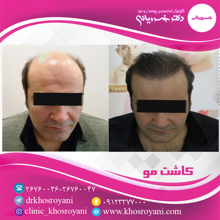 آیا موقعیت لوکیشن های کلینیک زیبایی تاثیری در هزینه کاشت مو دارد؟