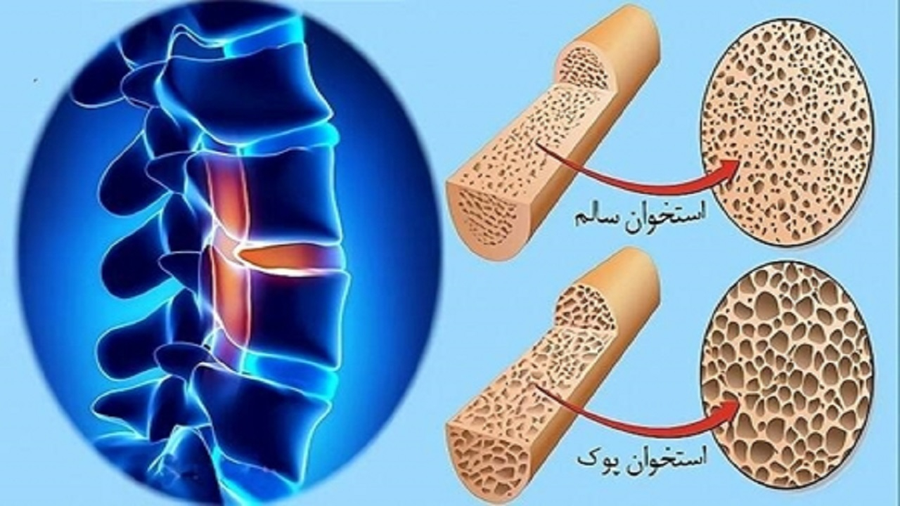 نیمی از زنان بالای ۵۰ سال کشور دچار پوکی استخوان هستند