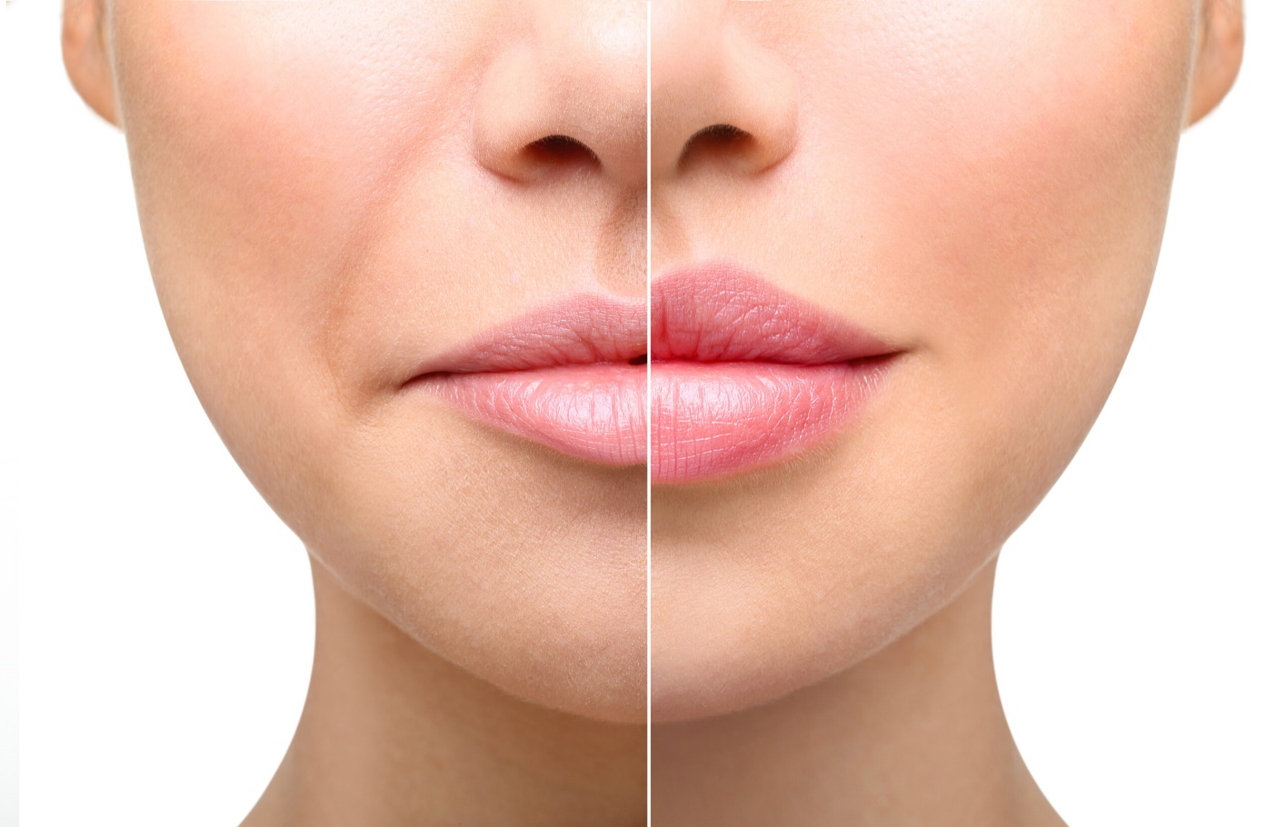 تزریق ژل لب برای چه کسانی مناسب است ؟