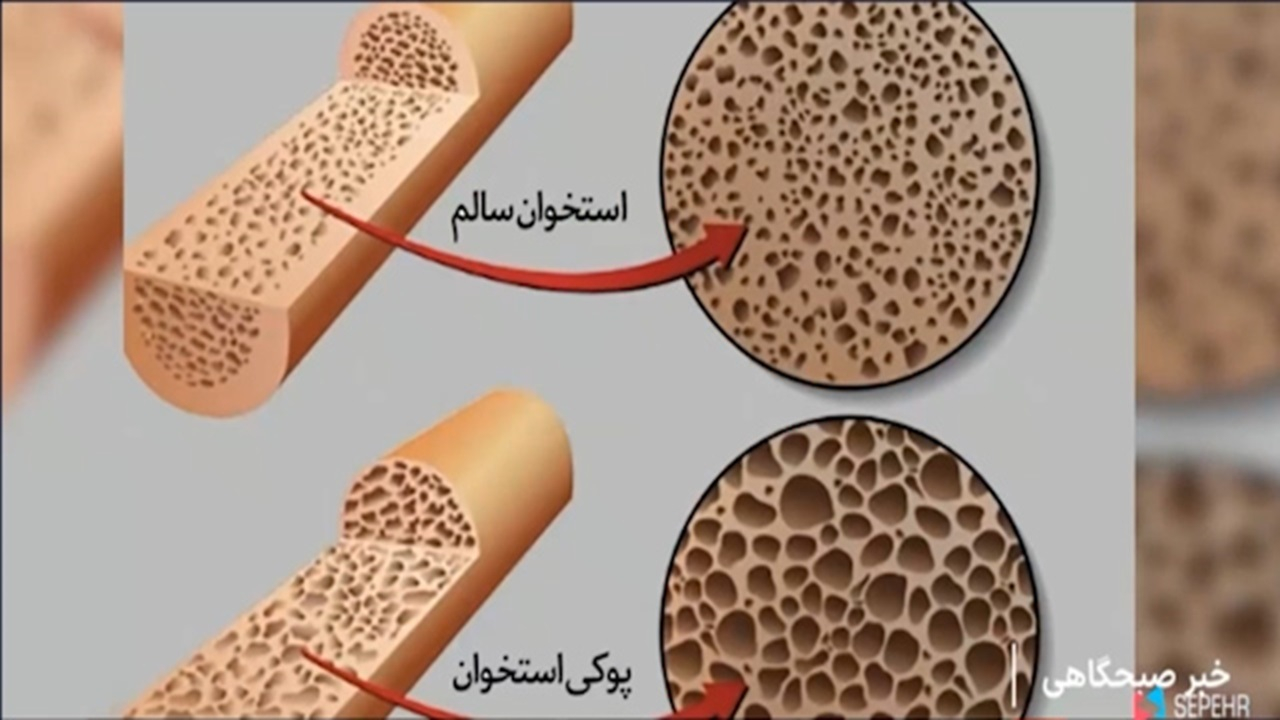ترمیم استخوان آسیب دیده با فناوری نانو + فیلم
